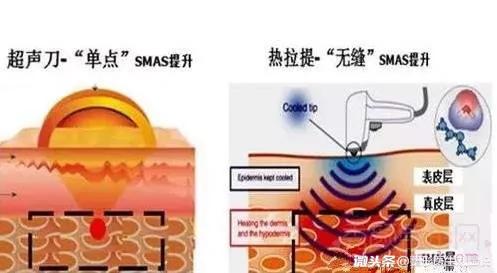 微整形要关注些什么,微整形要关注什么