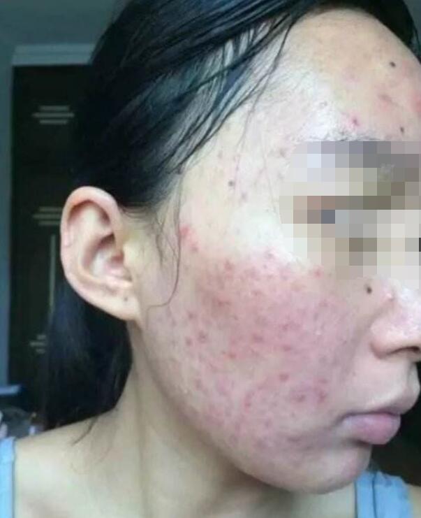 卸妆之后怎么护肤避免长痘,卸妆后脸部泛红刺痛长痘怎么办