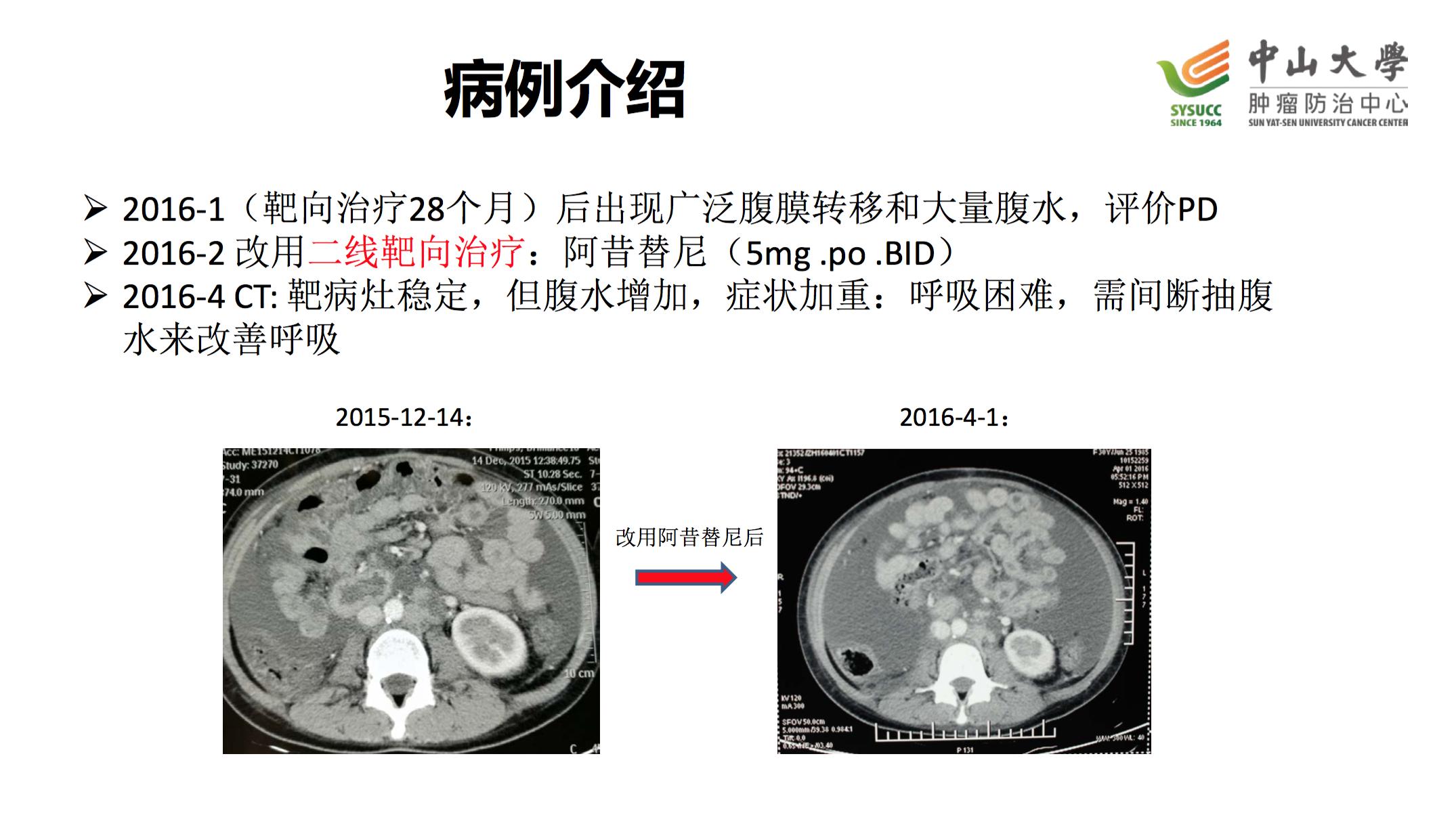 阿昔替尼联合pd-1治疗肾癌,肾癌阿昔替尼耐药后怎么治疗