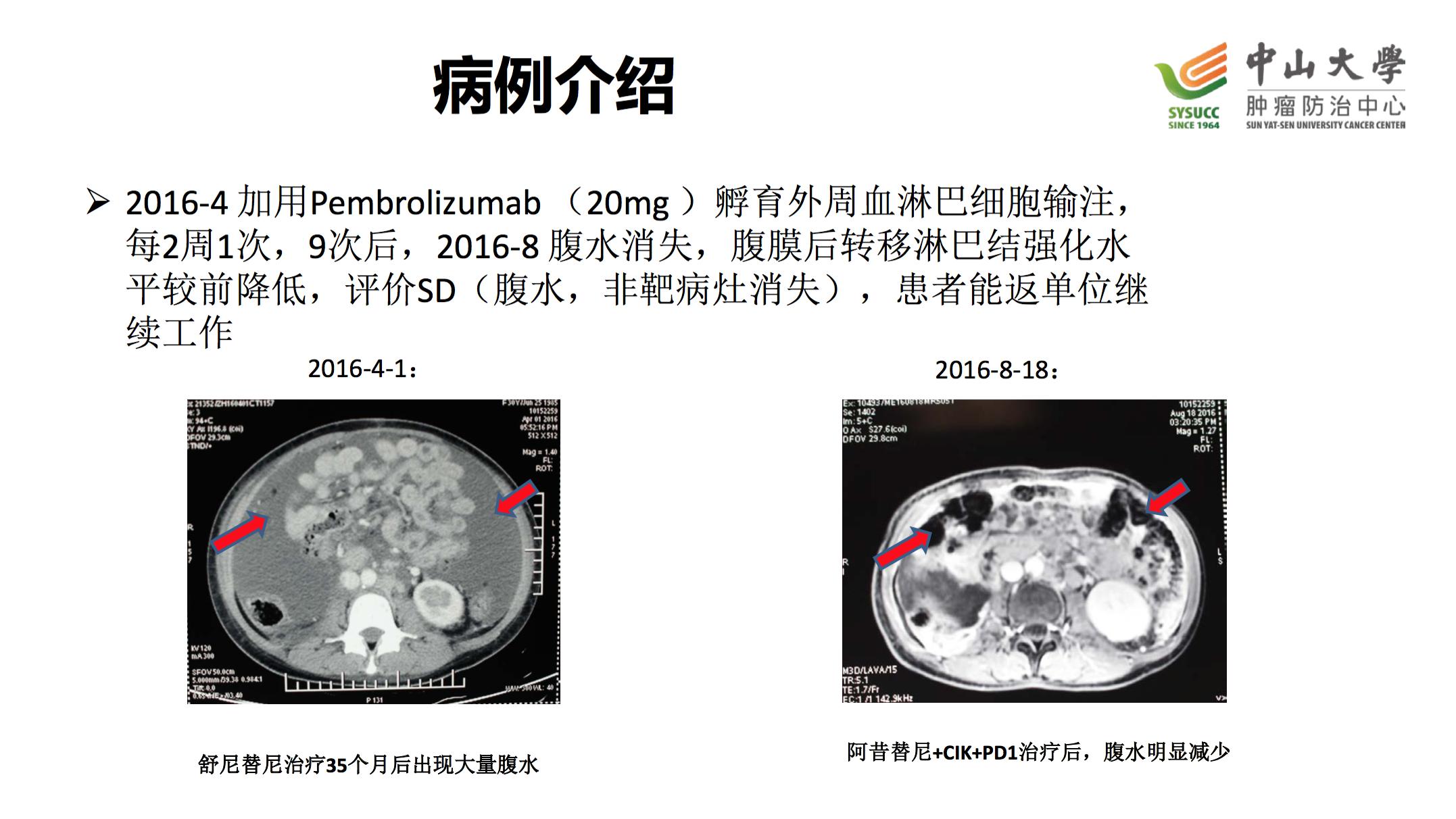 阿昔替尼联合pd-1治疗肾癌,肾癌阿昔替尼耐药后怎么治疗