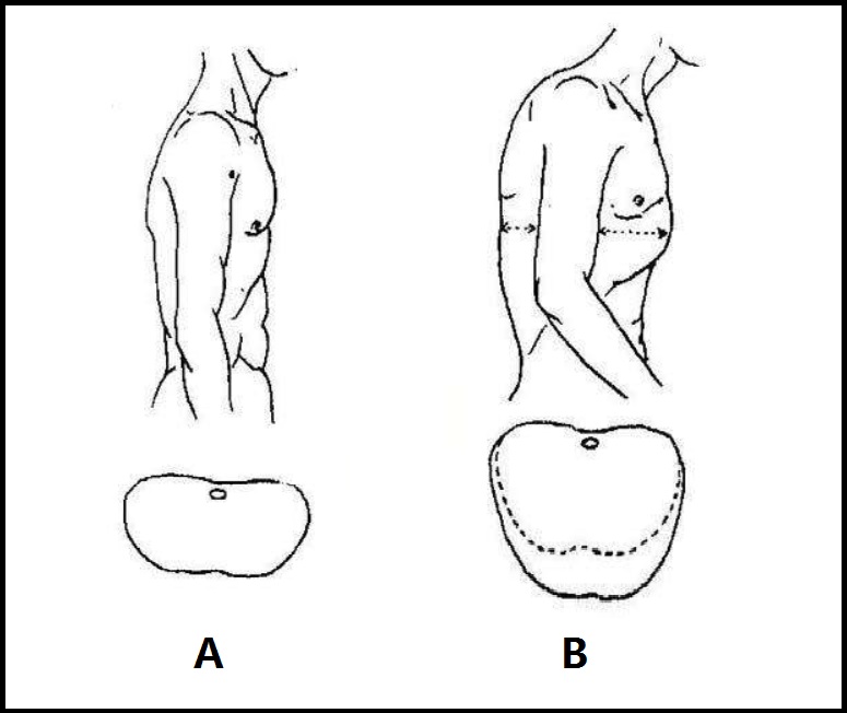 桶状胸手术,先天性桶状胸