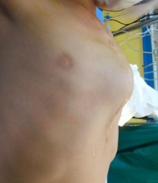 桶状胸手术,先天性桶状胸