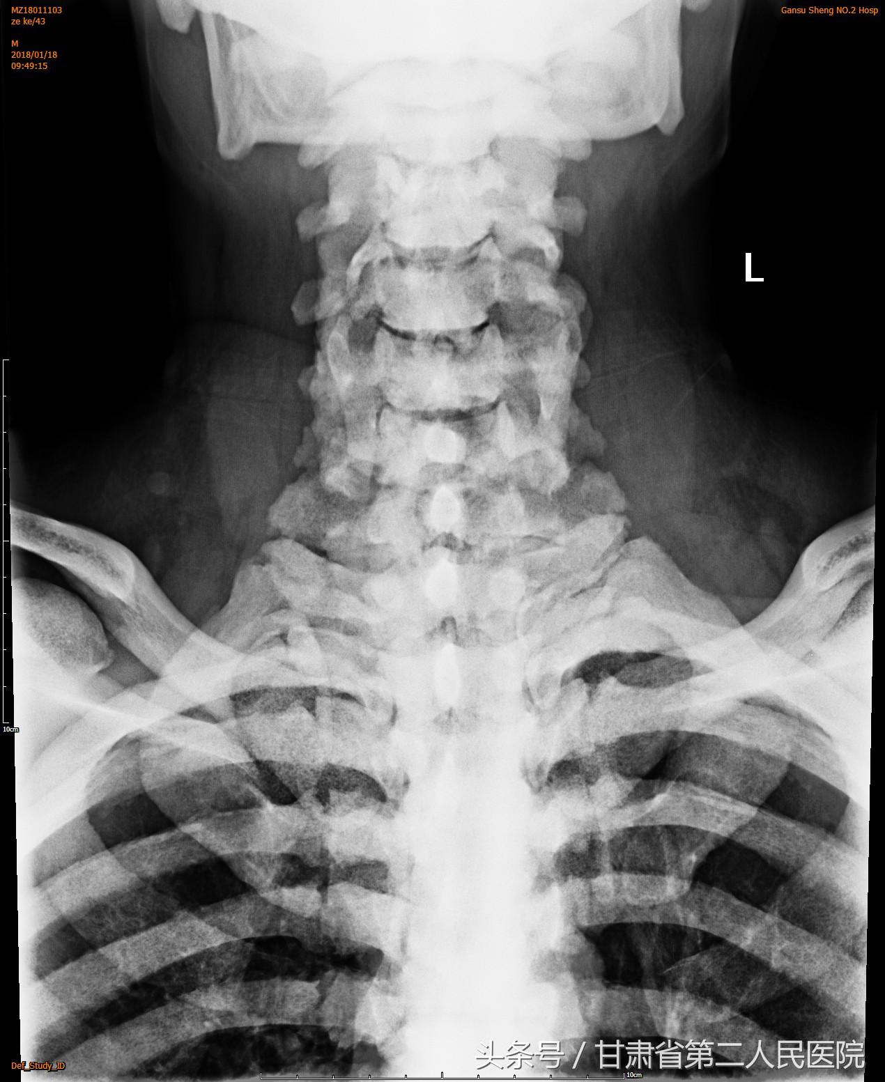 颈椎病折磨了20年,重度颈椎病的外科治疗