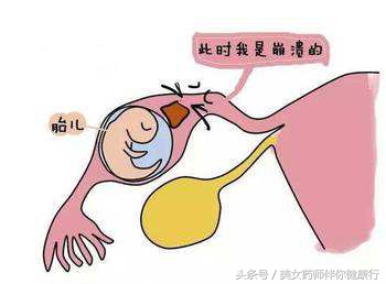 备孕前怎么避免宫外孕发生呢,备孕前怎么避免宫外孕