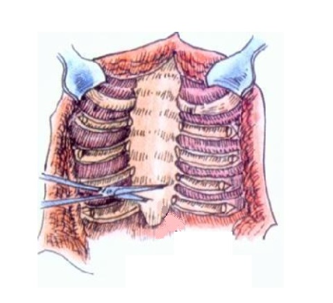 鸡胸超微创手术,鸡胸微创手术3d图