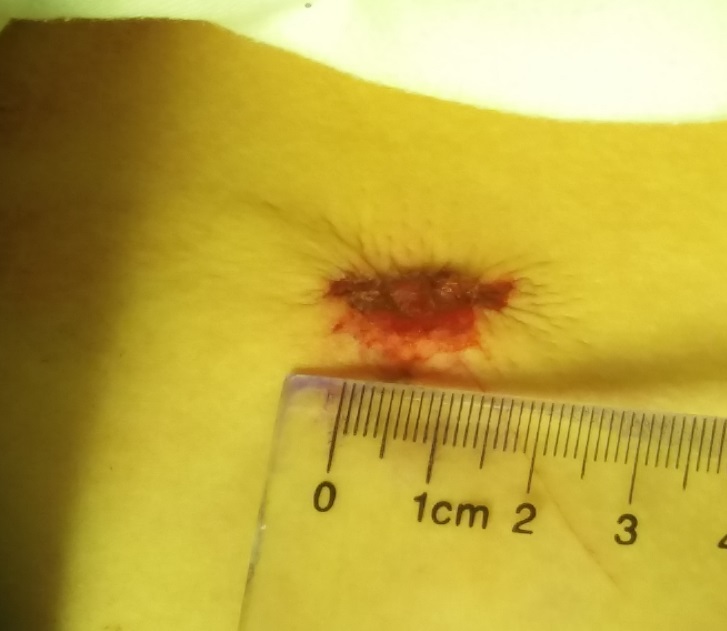 鸡胸超微创手术,鸡胸微创手术3d图