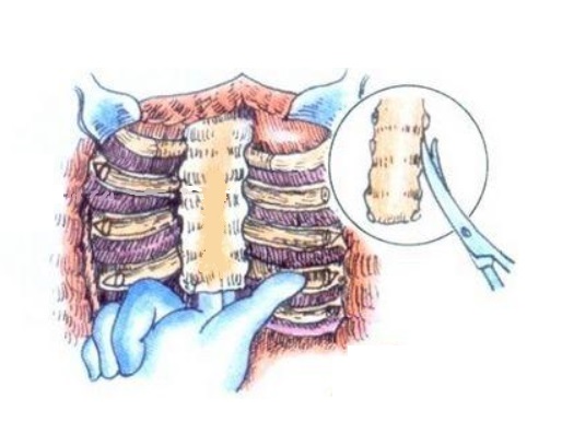 鸡胸超微创手术,鸡胸微创手术3d图