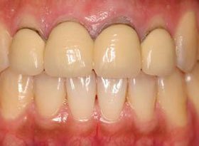 牙龈引起的口臭怎么解决,牙龈口臭牙根发黑