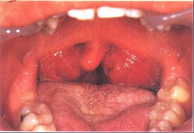 医生说婴儿喉咙有点红,喉咙红有血丝需要吃消炎药吗
