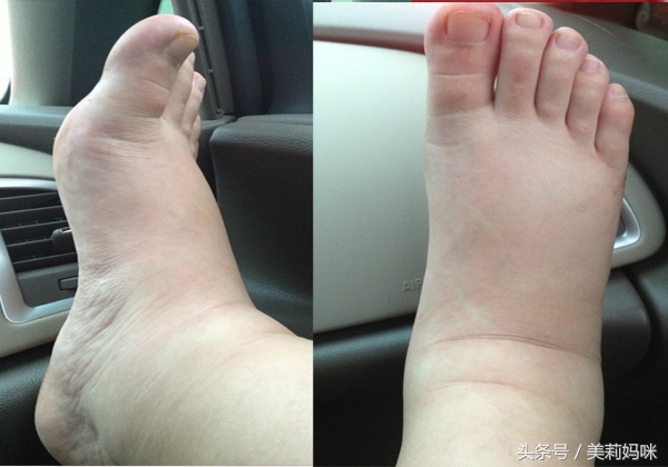 孕早期胎儿水肿能不能自愈,孕妈怀孕36周水肿是什么原因