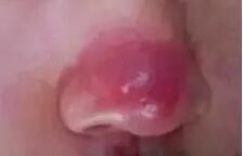 鼻子红红的酒糟鼻怎么护肤,鼻子怎么解辣