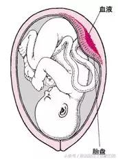 产科医生一般不会告诉你，这5种情况他们可能会考虑采取剖宫产！