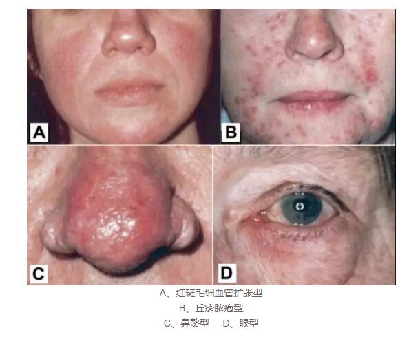 鼻子红红的酒糟鼻怎么护肤,鼻子怎么解辣