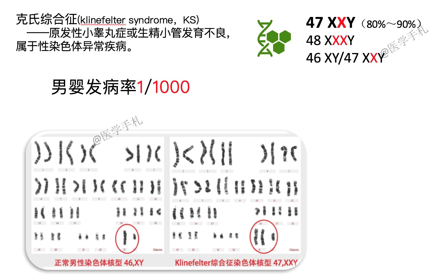 克氏综合征未来可以攻克吗,克氏综合征最新研究成果