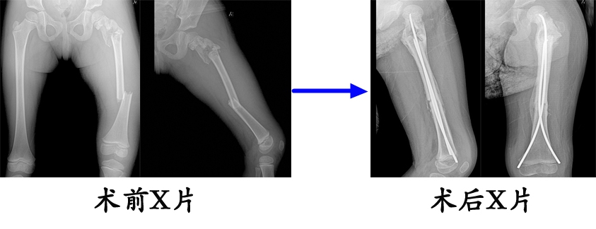 股骨干骨折术后功能锻炼,儿童股骨干骨折治疗方案
