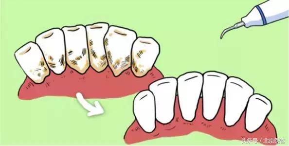 刷牙牙龈老是出血是上火了吗,刷牙牙龈爱出血是上火嘛