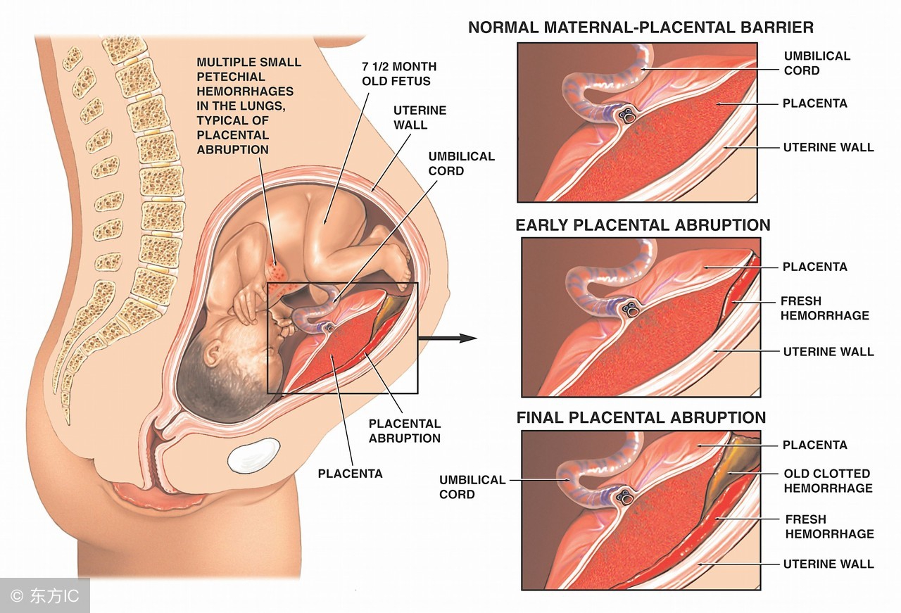 胎盘低置离宫口16毫米能生吗,胎盘距离宫颈口多少算胎盘低置