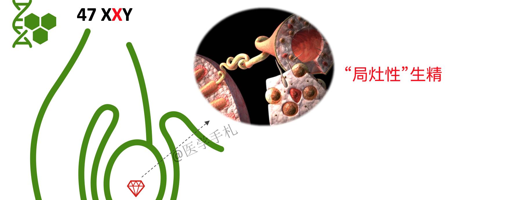 克氏综合征未来可以攻克吗,克氏综合征最新研究成果