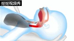 儿童呛到气管急救措施视频,儿童气管呛入异物怎么取出