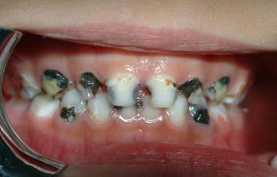 宝宝牙齿发黑是什么原因引起的,宝宝牙齿有点发黑是怎么回事