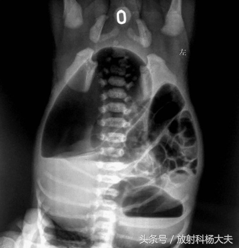 “孩子没*眼屁**”不可怕，是婴儿常见的消化道畸形，好治