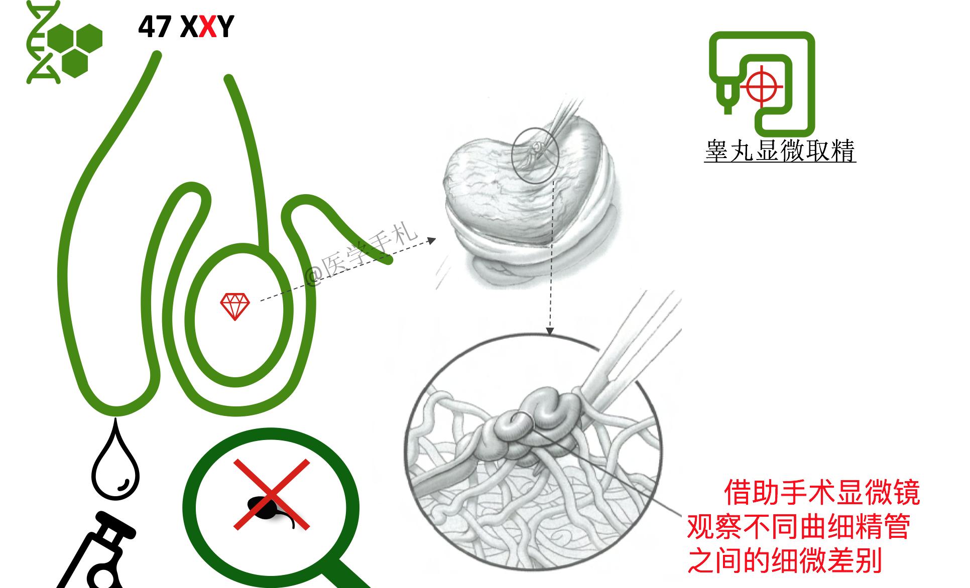 克氏综合征未来可以攻克吗,克氏综合征最新研究成果