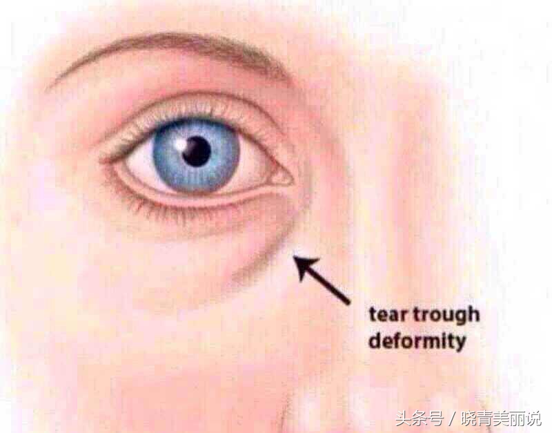 卧蚕会变成眼袋吗,卧蚕是怎么变成眼袋的