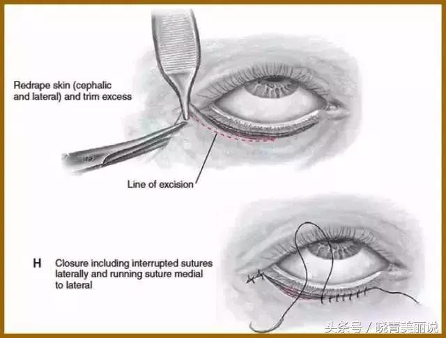 卧蚕会变成眼袋吗,卧蚕是怎么变成眼袋的