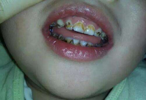 宝宝牙齿发黑是什么原因引起的,宝宝牙齿有点发黑是怎么回事
