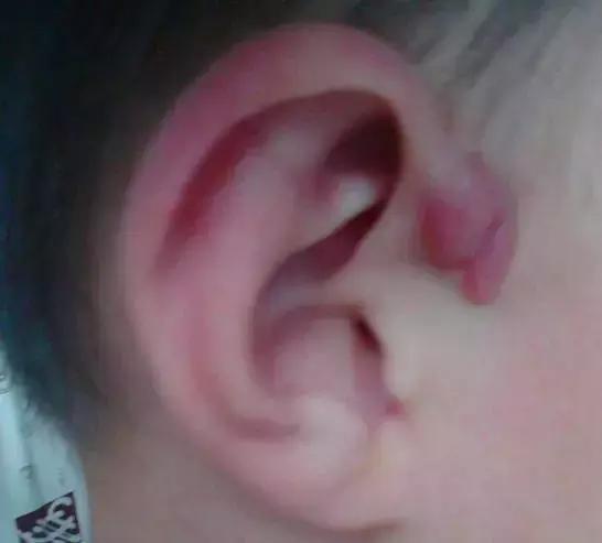 耳朵上方有个小孔流脓是怎么回事,耳朵的富贵洞能治好吗