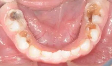 小孩牙疼一定不要轻易去治疗,家长们不可大意