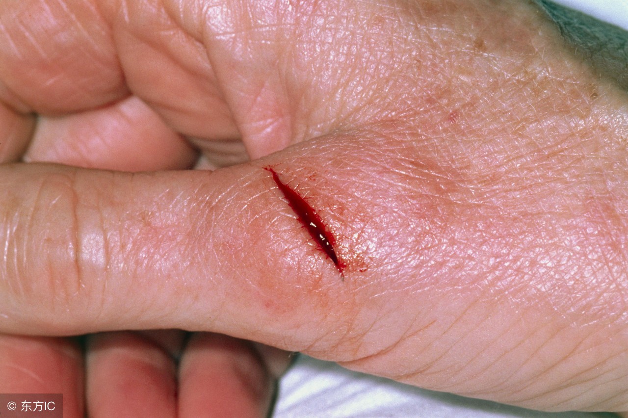 小刀划破手指要打碎伤风吗,手被小刀划破了不停的流血怎么办