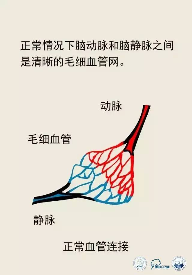 熊猫医生阿缪：脑动静脉畸形怎么破