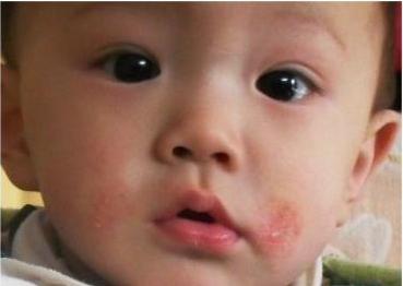 湿疹治疗过程中需要关注什么,宝宝湿疹大作战图文