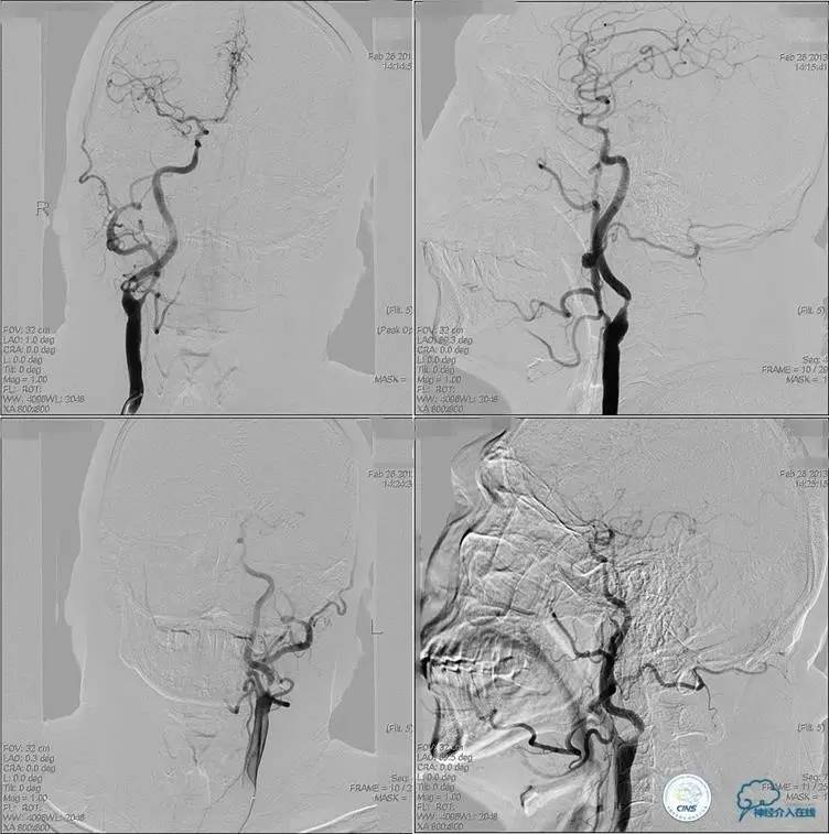 椎基底动脉闭塞严重吗怎么治疗,椎基底动脉局部闭塞微创手术