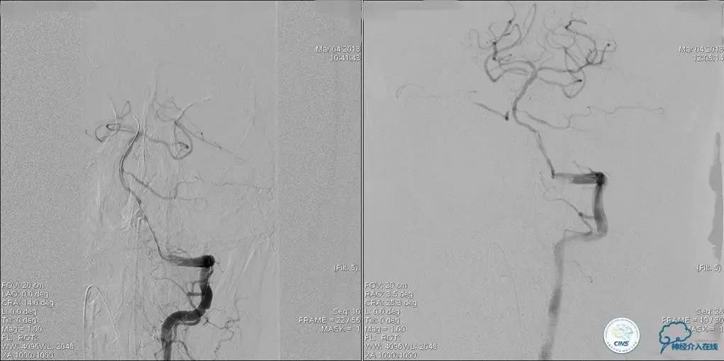 椎基底动脉闭塞严重吗怎么治疗,椎基底动脉局部闭塞微创手术