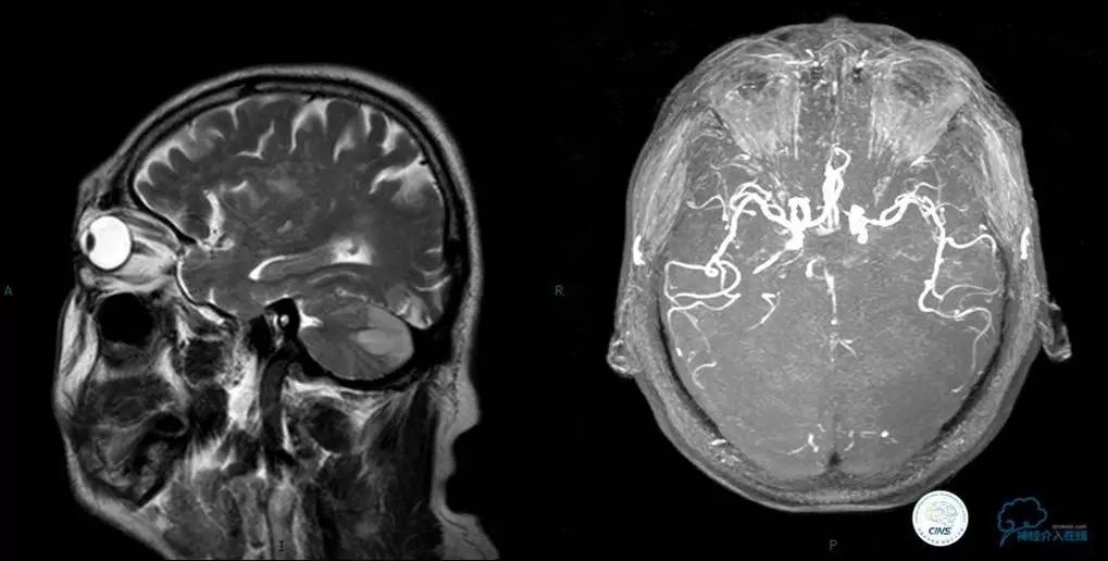 椎基底动脉闭塞严重吗怎么治疗,椎基底动脉局部闭塞微创手术