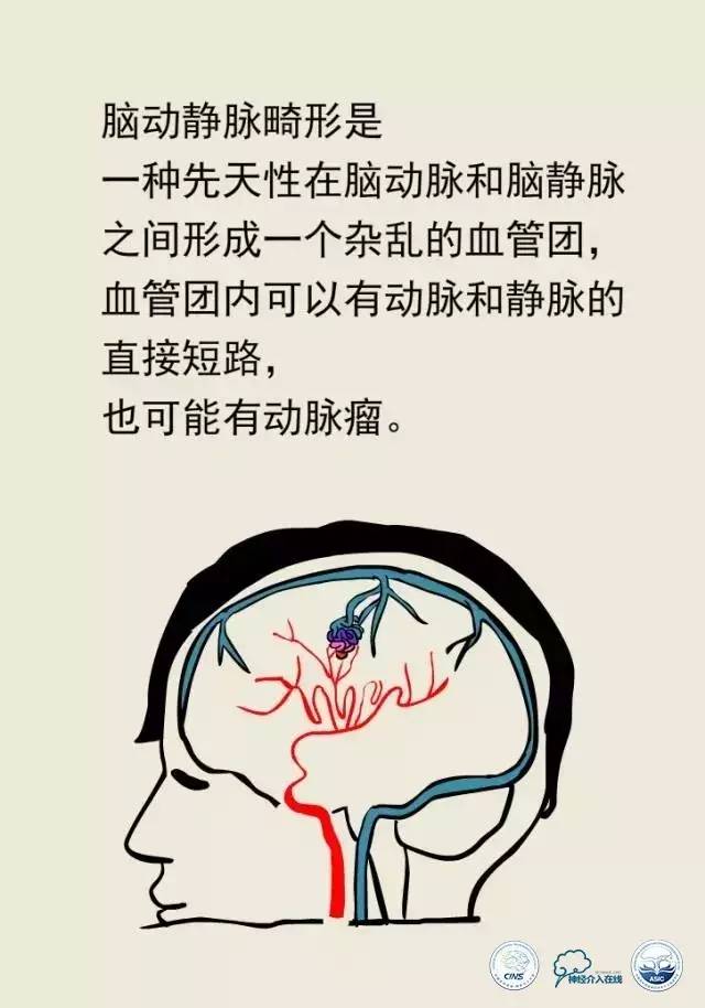 熊猫医生阿缪：脑动静脉畸形怎么破