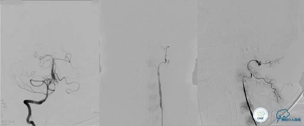 椎基底动脉闭塞严重吗怎么治疗,椎基底动脉局部闭塞微创手术