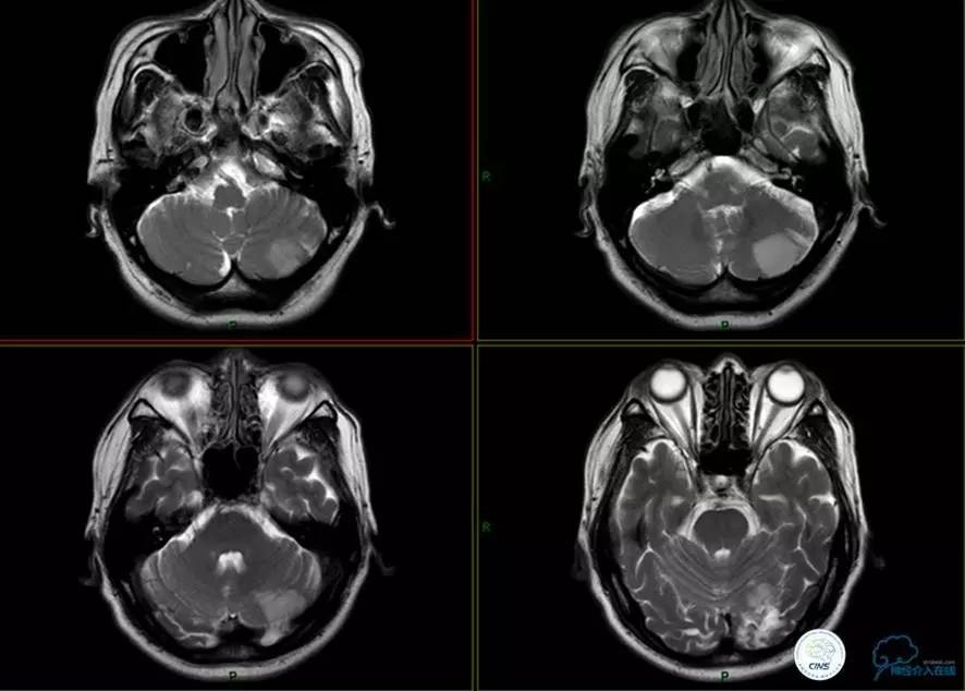 椎基底动脉闭塞严重吗怎么治疗,椎基底动脉局部闭塞微创手术