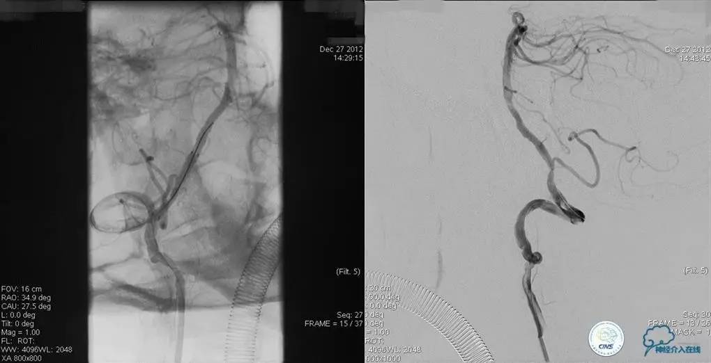 椎基底动脉闭塞严重吗怎么治疗,椎基底动脉局部闭塞微创手术