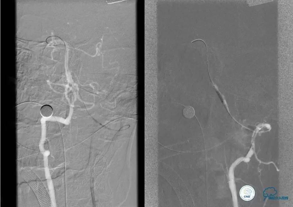椎基底动脉闭塞严重吗怎么治疗,椎基底动脉局部闭塞微创手术