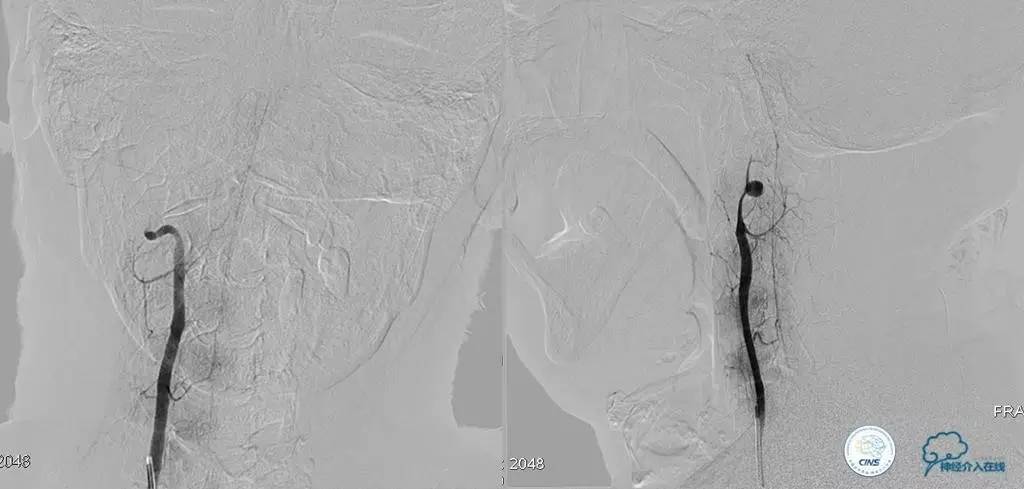 椎基底动脉闭塞严重吗怎么治疗,椎基底动脉局部闭塞微创手术