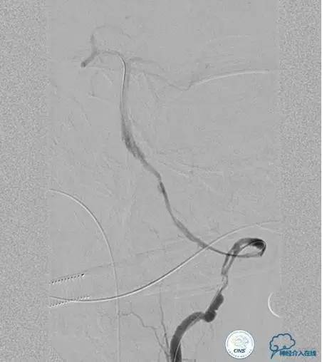 椎基底动脉闭塞严重吗怎么治疗,椎基底动脉局部闭塞微创手术