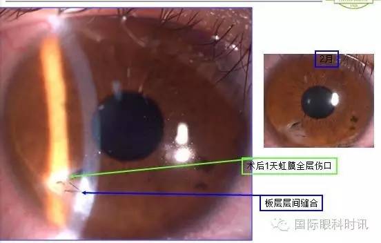 角膜水肿的处理方法,眼睛角膜水肿后遗症