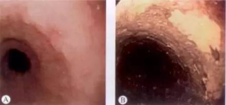 食管癌早期筛查手段,早期食管癌内镜的切除方式有哪些