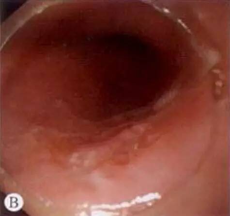 食管癌早期筛查手段,早期食管癌内镜的切除方式有哪些
