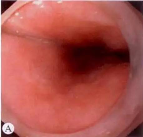 食管癌早期筛查手段,早期食管癌内镜的切除方式有哪些