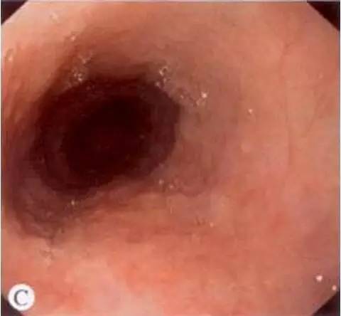 食管癌早期筛查手段,早期食管癌内镜的切除方式有哪些