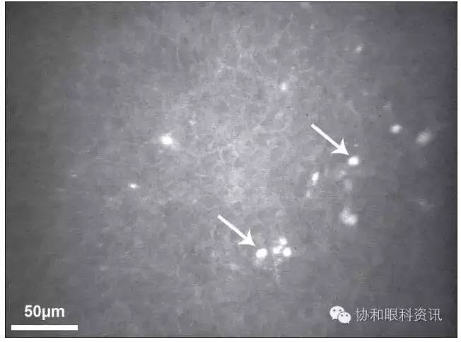 文摘速递棘阿米巴角膜炎：糖皮质激素禁区？